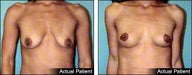 Breast lift