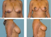 Breast reduction