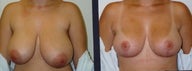 Breast reduction