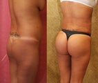 Butt augmentation