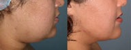 Chin liposuction