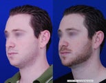 Chin liposuction