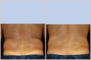 CoolSculpting