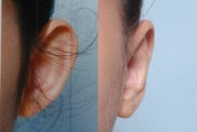 Ear surgery