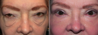 Eye Bags Treatment