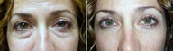 Eyelid Surgery
