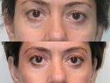 Eyelid Surgery