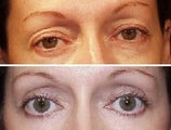 Eyelid Surgery