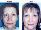 Eyelid Surgery
