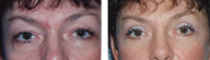 Eyelid Surgery