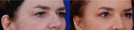 Eyelid Surgery