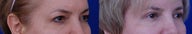 Eyelid Surgery