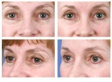 Eyelid Surgery