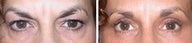 Brow lift