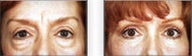 Eyelid Surgery