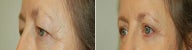 Eyelid Surgery