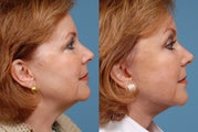 Facelift