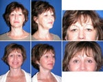 Facelift