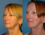 Facelift