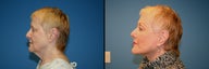Facelift
