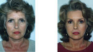 Facelift