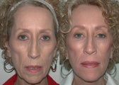 Facelift