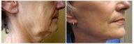 Facelift
