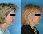 Facelift