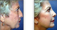 Facelift