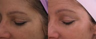 Fractional laser