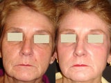 Fraxel Laser