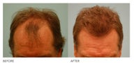 Hair transplant