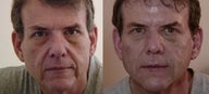 Injectable fillers