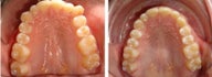 Invisalign