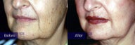 Laser resurfacing