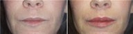 Lip augmentation