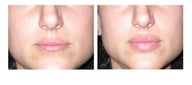 Lip augmentation