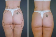 Liposculpture