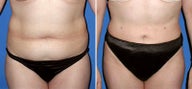 Liposculpture