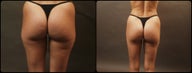Liposuction