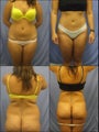 Liposuction