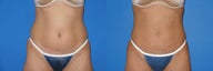 Liposuction