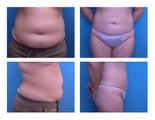 Liposuction