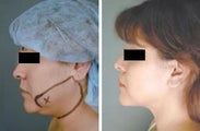 Liposuction