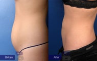 Liposuction