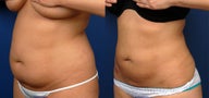 Liposuction