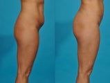 Liposuction