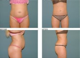 Liposuction