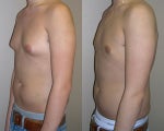 Male breast reduction