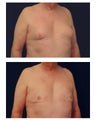 Male breast reduction
